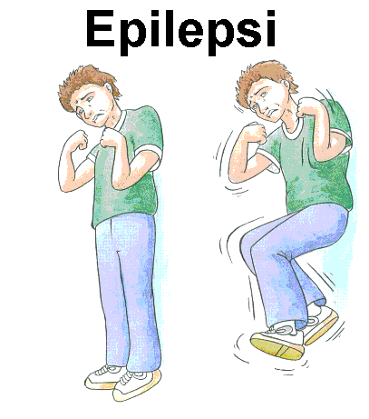 Apa itu Epilepsi? Obat-obatan yang telah